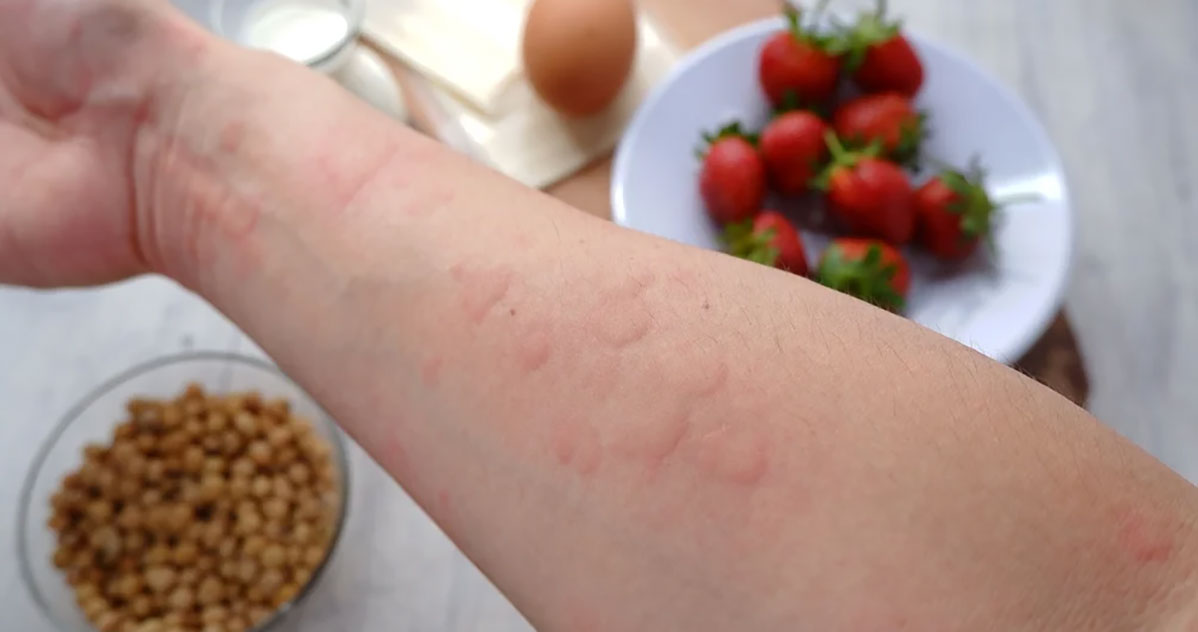 Alergije akutne ili hronične – Simptomi, dijagnostika i lečenje