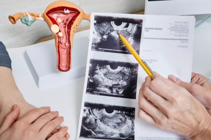 PMOS umesto PCOS — zašto se menja naziv sindroma policističnih jajnika i šta to zapravo znači?